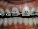 Figure 17  View of the power chain between the central incisors to start space closure.