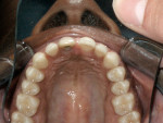 Figure 22  Incisal view of the final orthodontic position of the teeth.