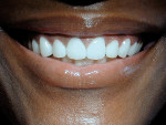 Figure 29  Closeup facial view of the patient in natural smile.