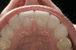 Figure 4  The final feldspathic restorations demonstrated satisfactory function and esthetics