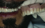 Figure 5  Facial view of old denture and new implantsupported bridge.