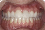 Figure 13  A 40-year-old patient presented with an avulsed left central incisor that had been bonded to the adjacent teeth.
