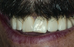 Figure 6  Completed implant-supported fixed bridge, 20 years, postoperative photo.