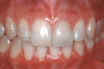 Figure 2  Postoperative view of an all-ceramic crown on the maxillary left central incisor displaying gingival health at the 10-year recall (crown created by Jack Fountain, CDT).