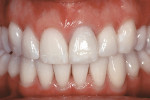 Figure 6  An all-ceramic crown restoration on the maxillary left central incisor displaying gingival health at the six-week recall (crown created by Steve McGowan, CDT).