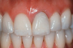 Figure 7  An all-ceramic crown restoration on the maxillary left central incisor displaying gingival recession at the one-year recall.