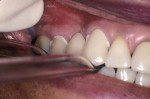Figure 4  View showing the application of seating force with the patient biting on a saliva ejector during the cementation of a fixed partial denture using a glass ionomer cement.<sup>h</sup>