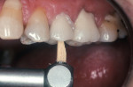 Figure 5  A reciprocating handpiece<sup>g</sup> with a wooden insert and PDS/MJ2 tip was used to fully seat the crown being cemented with resin cement<sup>i</sup> using active mechanical