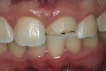 Figure 1  Preoperative view of fractured tooth No. 9. Tooth No. 8 demonstrates heavy texture.