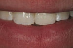 Figure 2  Postoperative view of tooth No. 9 restored using a zirconia framework<sup>a</sup> with an initial porcelain layer on top<sup>b</sup>. Note that the heavy texture matches the preoperative condition of tooth No. 8.