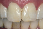 Figure 4  The crown completed for tooth No. 8 matches the medium texture of tooth No. 9.