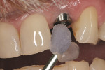 Figure 5  Preoperative view of the left lateral implant. Adjacent teeth demonstrate a glossy texture.