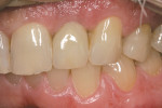 Figure 6  The lateral crown matches the glossy texture of the adjacent central and canine.