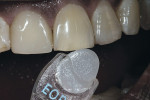 Figure 8  An enamel opal tab is used to determine the incisal and value.