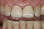 Figure 15  Teeth Nos. 8 and 9 presented with old porcelain-fused-to-metal (PFM) crowns.