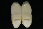 Figure 16  All-ceramic crowns are compared to PFM crowns to demonstrate the same high esthetics that are now possible.