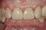 Figure 17  Teeth Nos. 8 and 9 were restored with all-ceramic crowns to replace the previous PFM restorations.