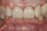 Figure 18  Here, however, new PFM crowns are used to restore the teeth.