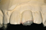 Figure 20  An indirect composite resin material<sup>c</sup> was selected to repair tooth No. 9, including the application of high details.