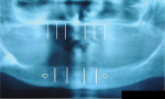 Figure 2  Panoramic x-ray with prospective implant locations and mental foramen marked.