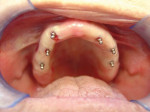 Figure 7  Implants placed in maxilla (immediate postoperative view).