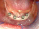 Figure 8  O-ring housing abutments on O-balls of mini implants.