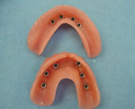 Figure 9: Upper and lower dentures with O-ring housings in place.