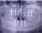 Figure 10  Postoperative radiograph with upper and lower mini implants in place.<sup>5</sup>
