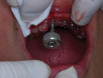 Figure 13  Implant placement using a finger driver.