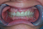Figure 15  Cemented crowns in place (immediate postoperative view).