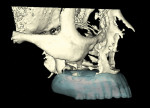 Figure 5 Screen captures from the NobelClinician software program after conversion of the DICOM files to the 3-D virtual working model: