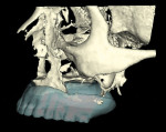 Figure 6 Screen captures from the NobelClinician software program after conversion of the DICOM files to the 3-D virtual working model: