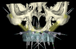Figure 8  Screen captures of the completed virtual implant planning: frontal view (Fig 8); left lateral view (Fig 9); right lateral view (Fig 10); occlusal view (Fig 11); occlusal view of implants only (Fig 12).