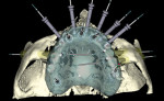 Figure 11  Screen captures of the completed virtual implant planning: frontal view (Fig 8); left lateral view (Fig 9); right lateral view (Fig 10); occlusal view (Fig 11); occlusal view of implants only (Fig 12).
