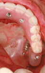Figure 16  A temporary coping or impression coping can be used with a long guide pin to pick up the position of the abutment placed on the zygoma implant.
