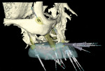 Figure 9 Screen captures of the completed virtual implant planning: frontal view (Fig 8); left lateral view (Fig 9); right lateral view (Fig 10); occlusal view (Fig 11); occlusal view of implants only (Fig 12).
