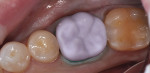 Figure 16 The restoration turned a natural tooth color, and was placed into the patientâ€™s mouth with a fourth-generation bonding agent and resin cement.