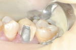 Figure 7 The tribochemically treated surface of tooth No. 4.