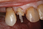 Figure 1 Endodontically treated teeth with fiber-post placement.