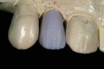 Figure 4 IPS e.max CAD Impulse blocks after milling and customization with laboratory burs.
