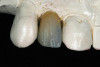 Fig 9. Provisional restoration with GIC.