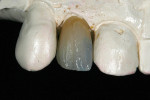 Figure 5 IPS e.max CAD Impulse esthetic stain and glaze on the stone die.