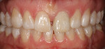 Figure 9 Image taken at the time of insertion of tooth No. 9 after firing to enhance the color blend with the adjacent teeth.