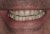 Fig 19. Clinical result after 200 days showing the satisfactory esthetics of the restorations.
