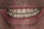 Figure 1 Preoperative view of the patient's smile.