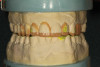 Fig 4. Comparison of an unaltered titanium abutment (upper) and a shortened abutment with the retentive cementing grooves placed that has been electrochemically treated to diminish the metallic hue.