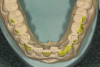 Fig 5. The scanned image of the abutment with the clearly defined screw-access hole.