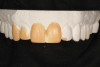Fig 11. Thinned brown stain applied to the occlusal surface.