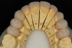 Figure 13 View of the lingual aspect of the fitted IPS e.max restorations on the master dies.