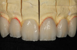 Figure 15 Powders were applied and then fired to mimic the internal effects of a natural tooth.